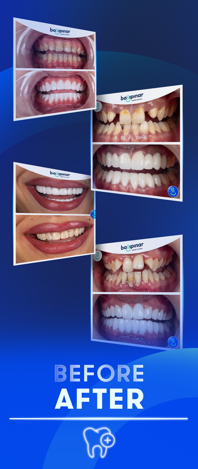 Ballıpınar before and after photos of dental treatments