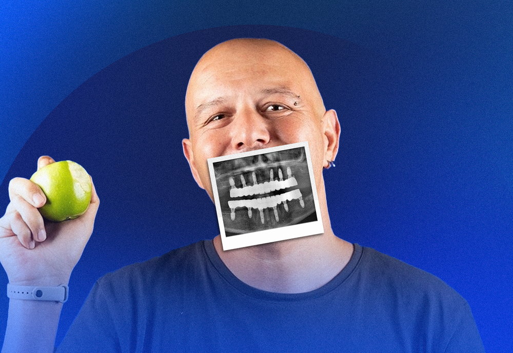 All-on-4 and All-on-6 patient holding the X-ray of his new fixed teeth