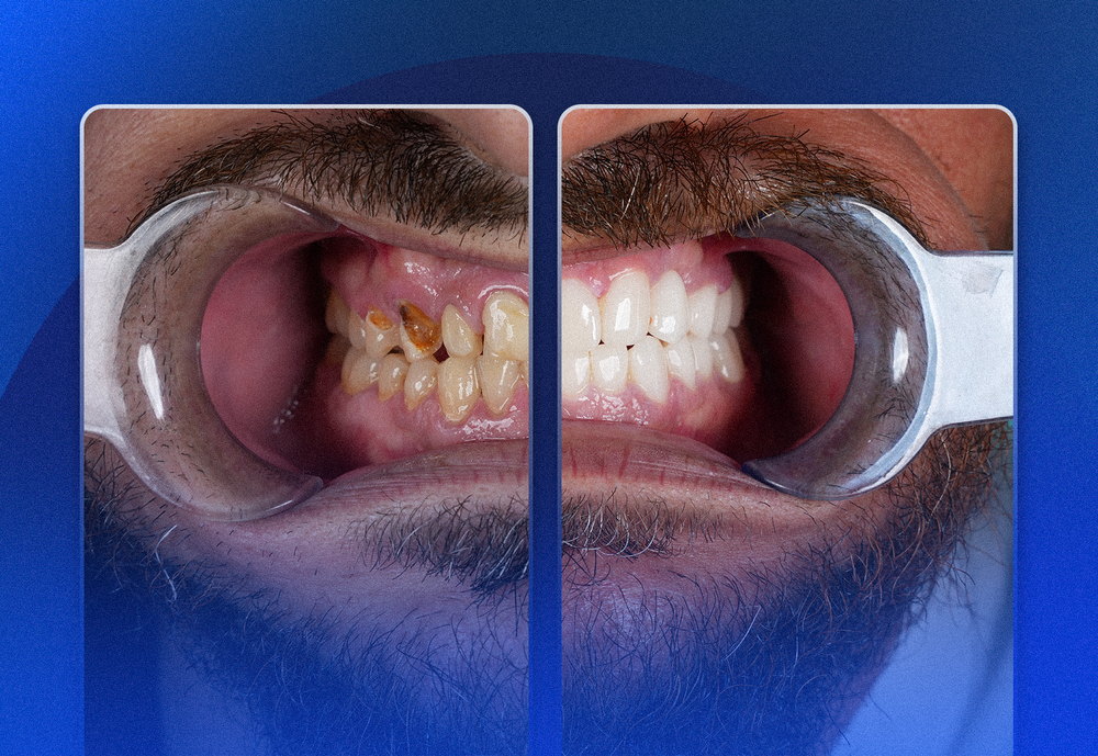 Before and after photo of worn teeth restored with dental crowns