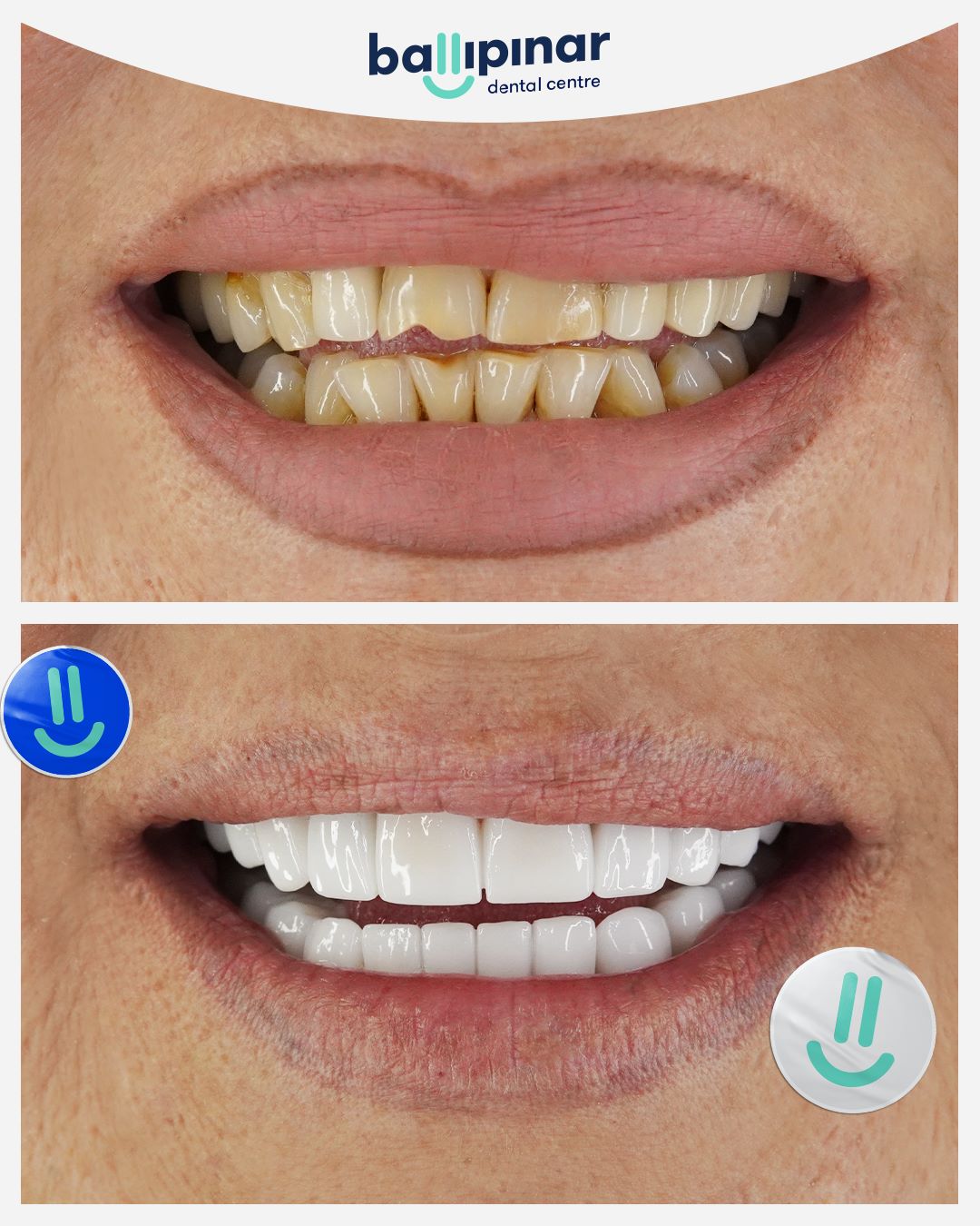 Dental Crowns Before and After Photos - Ballıpınar